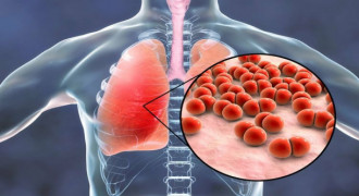 Kenali Apa itu Pneumonia, Penyakit Yang Sering Menimpa Balita